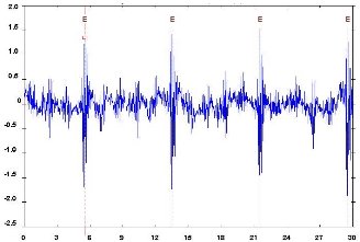 Machine Vibration Spectrum Analysis - Detecting Faults (5) - Tooth Repeat Signal (source: DDC)